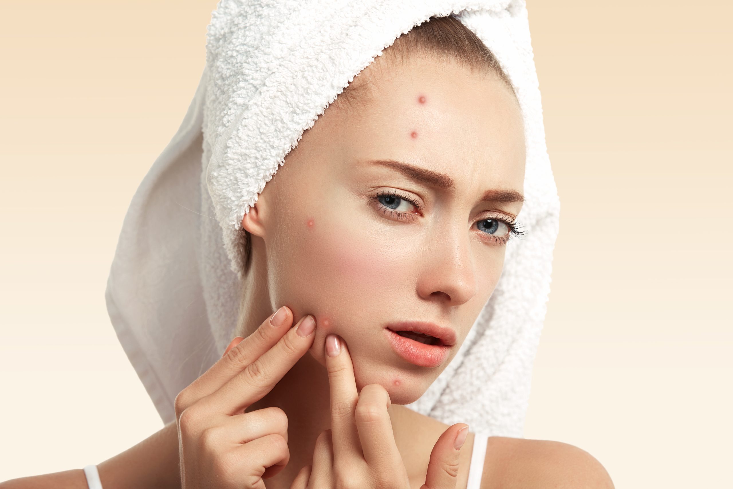 Revealing 5 Lifestyle Changes That Can Clear Your Acne