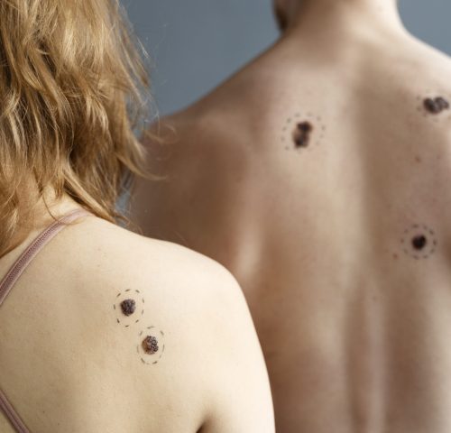 young-people-with-melanoma-back-view